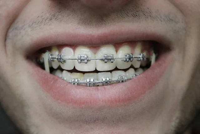 traitement orthodontique